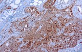 Anti-Calretinin CE/IVD for IHC - Pulmonary pathology