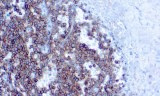 Anti-CD99 CE/IVD for IHC - Pediatric pathology