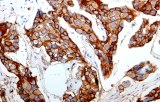 Anti-E-cadherin CE/IVD for IHC - Gynecological pathology