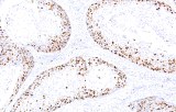 Anti-Ki-67 CE/IVD for IHC - Gynecological pathology