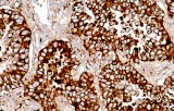 Anti-Napsin A CE/IVD for IHC - Pulmonary pathology