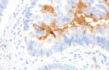 Anti-TAG-72 CE/IVD para IHC - Patología pulmonar