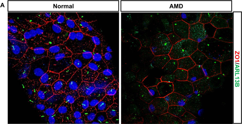 Confocal images stained for Arl13b (cat. 75-287, 1:2000; green) and ZO-1 (red) of healthy human RPE and AMD patient. Image from publication CC-BY-4.0. PMID:37211572