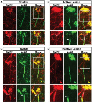 Representative cortical layer 5/6 pyramidal neurons from control, (B) active MS lesion, (C) NAGM, (D) inactive MS lesion tissues immunolabelled with anti-SMI32, and their AIS immunolabelled with anti-AnkG. White rectangles in the merged channel panels indicate magnification areas and are presented in the lower panels. Dashed lines indicate the contour of the soma, arrowheads indicate the start of the AIS, and white lines represent soma-AIS gaps. Image from publication CC-BY-4.0. PMID:36451656