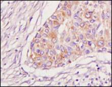 BRAF staining in breast carcinoma. Paraffin-embedded human breast carcinoma tissue is stained with BRAF Antibody (Cat. No. 251460) used at 1:300 dilution.