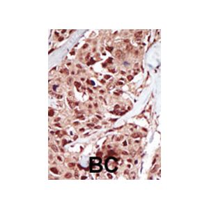 Human Cancer Cells