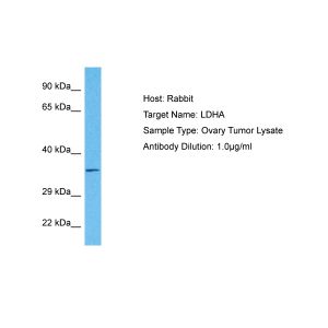 Human Ovary Tumor