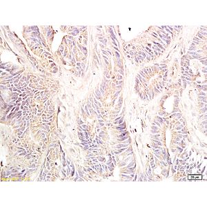 Human colon cancer tissue