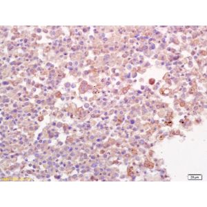 Human lung carcinoma