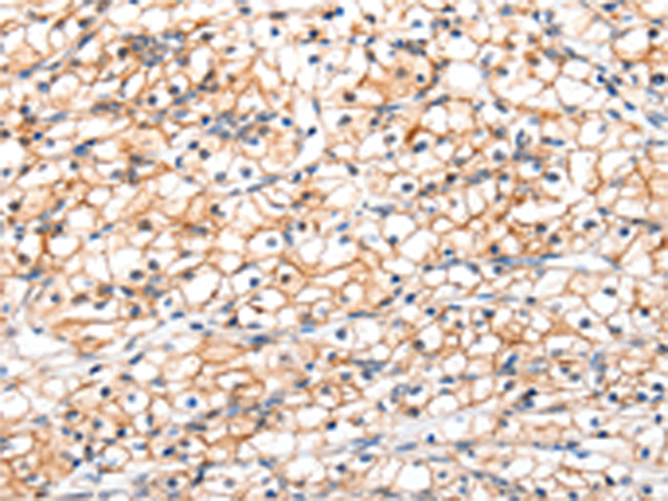 Immunohistochemistry of paraffin-embedded Human renal cancer tissue using TA321428 (GLP1R Antibody) at dilution 1/20 (Original magnification: ×200)